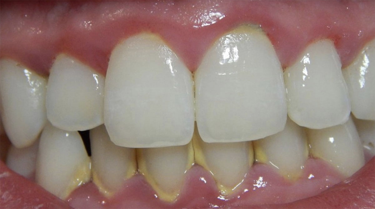 Grau kind wird zahn Zahnverfärbungen beim