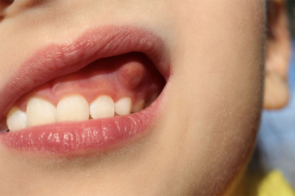 Anzeichen erster zahn Zahnen: 7